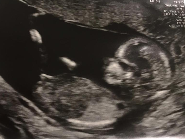 12 week pregnancy scan